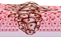 Câncer neoplasia